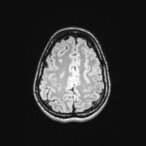 Atretic encephalocoele with inferior vermis hypoplasia (Radiopaedia 30443-31108 Axial 121).jpg