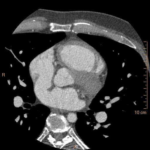 Atrial septal defect (upper sinus venosus type) with partial anomalous pulmonary venous return into superior vena cava (Radiopaedia 73228-83961 A 111).jpg