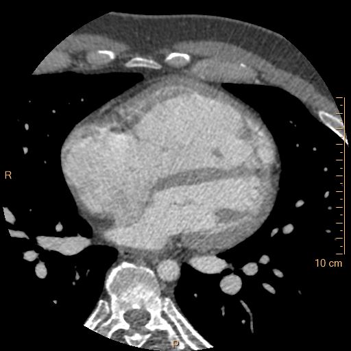 File:Atrial septal defect (upper sinus venosus type) with partial anomalous pulmonary venous return into superior vena cava (Radiopaedia 73228-83961 A 155).jpg