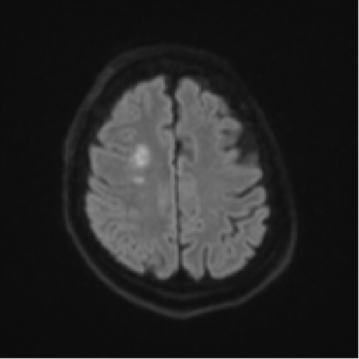 Atypical meningioma (WHO Grade II) (Radiopaedia 54742-60981 Axial DWI 49).png