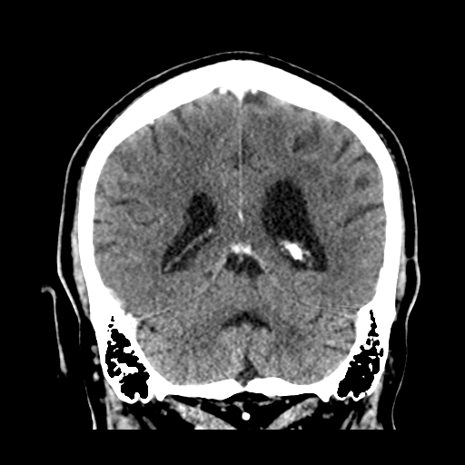 Atypical meningioma (WHO grade II) with brain invasion (Radiopaedia 57767-64728 Coronal C+ 43).png