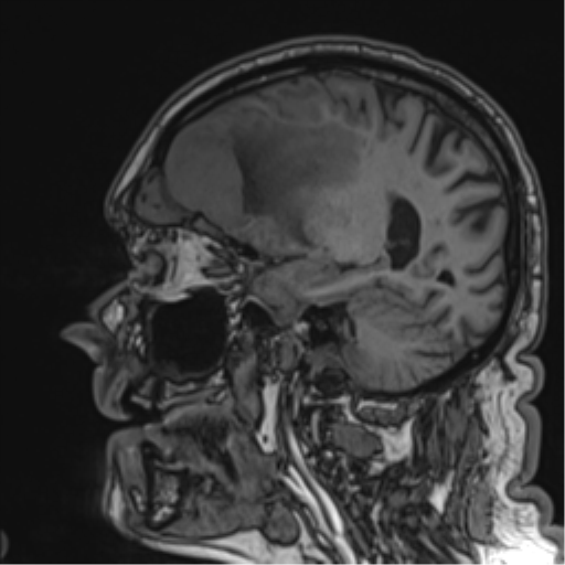 Atypical meningioma (WHO grade II) with brain invasion (Radiopaedia 57767-64729 Sagittal T1 44).png