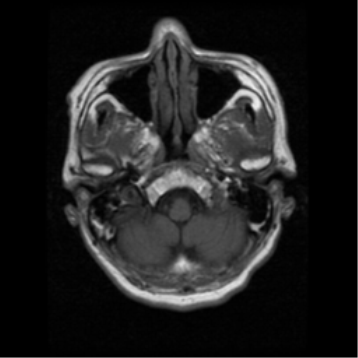 File:Atypical meningioma (WHO grade II) with osseous invasion (Radiopaedia 53654-59716 Axial T1 3).png