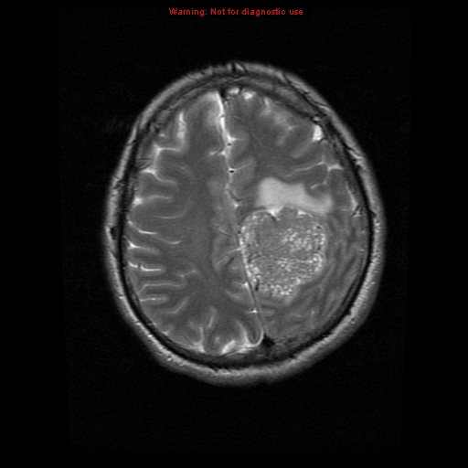 File:Atypical meningioma - grade II (Radiopaedia 13303-13305 Axial T2 17).jpg