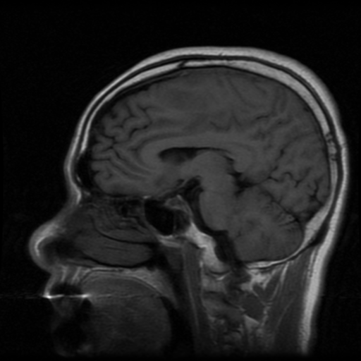 File:Atypical meningioma with skull invasion (Radiopaedia 34357-35648 Sagittal T1 13).png