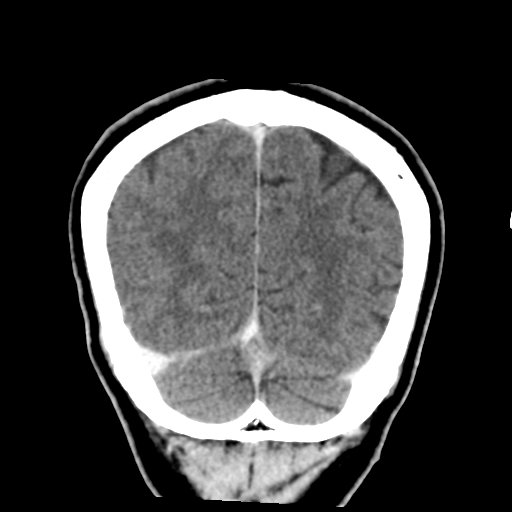 Atypical meningioma with skull invasion (Radiopaedia 34357-35649 Coronal C+ delayed 49).png