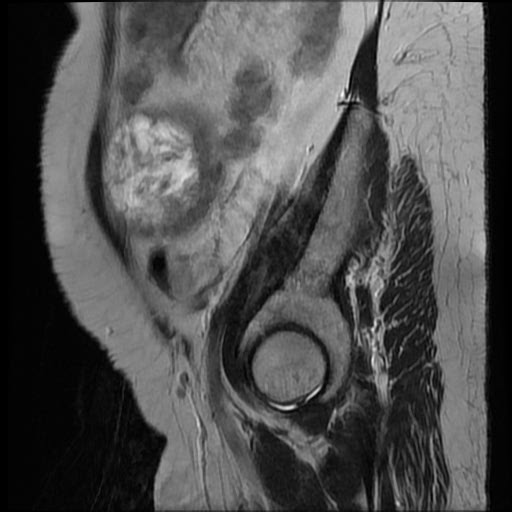 File:Atypical retroperitoneal lymphocoeles with large leiomyoma of uterus (Radiopaedia 32084-33027 Sagittal T2 28).jpg