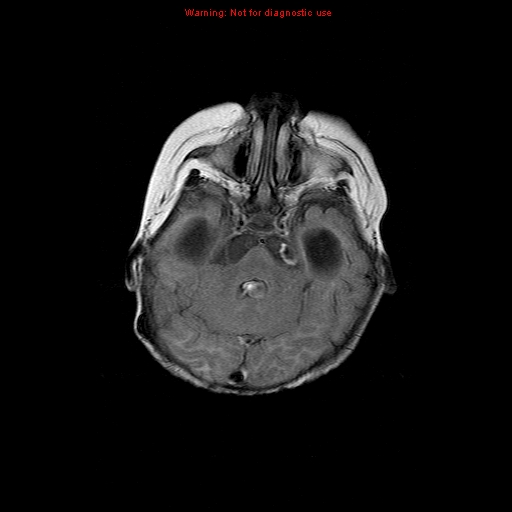 File:Atypical teratoid rhabdoid tumor (Radiopaedia 10712-11183 Axial FLAIR 13).jpg
