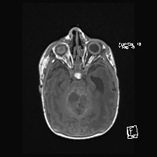 Atypical teratoid rhabdoid tumor (prenatal US and neonatal MRI) (Radiopaedia 59091-66388 Axial T1 21).jpg
