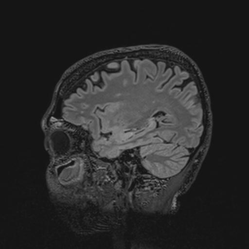 Autoimmune limbic encephalitis (Radiopaedia 30363-31005 Sagittal FLAIR 109).jpg