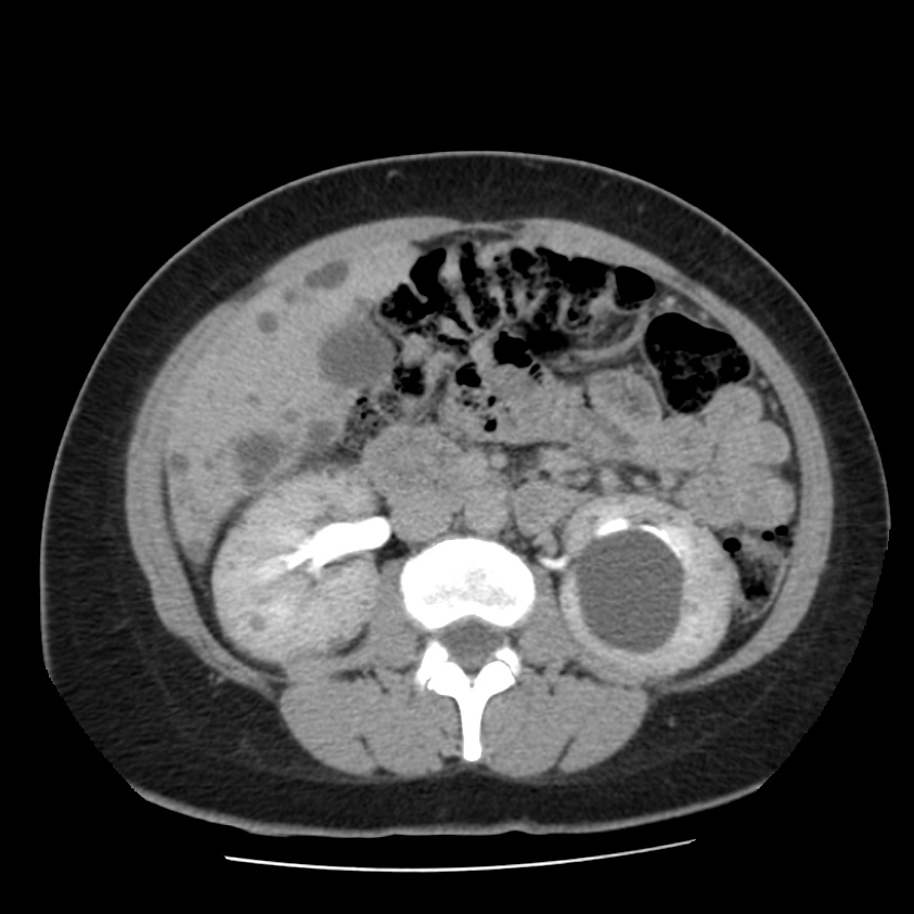 Autosomal dominant polycystic kidney disease (Radiopaedia 23061-23093 C+ delayed 32).jpg