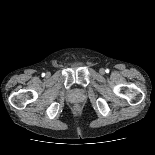 Autosomal dominant polycystic kidney disease (Radiopaedia 27851-28094 B 122).jpg