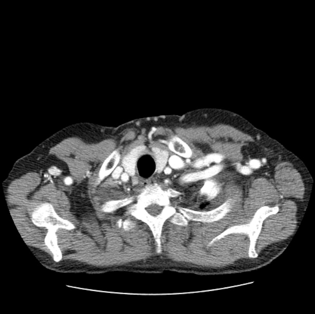 Autosomal dominant polycystic kidney disease (Radiopaedia 27851-28094 B 5).jpg