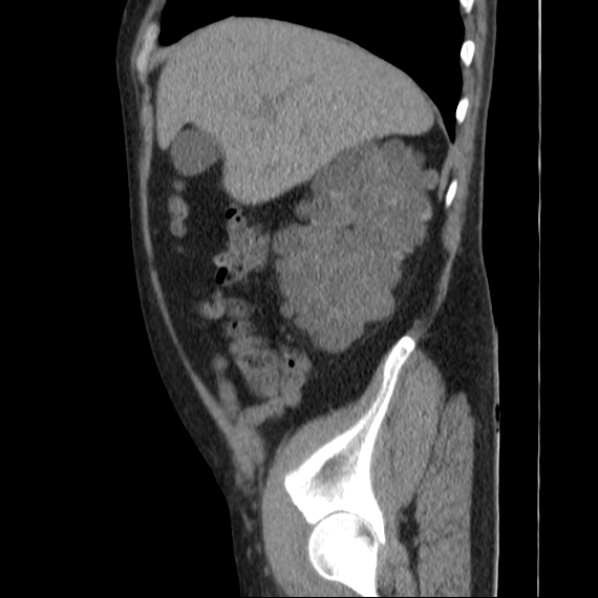 Autosomal dominant polycystic kidney disease (Radiopaedia 36539-38101 D 21).jpg