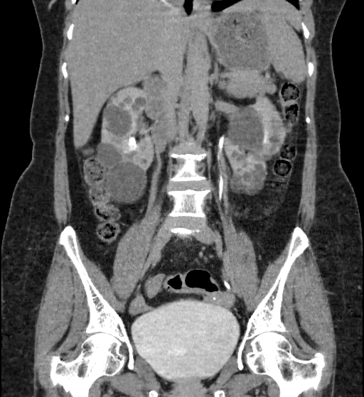 File:Autosomal dominant polycystic kidney disease (Radiopaedia 38189-40194 Coronal C+ delayed 47).jpg