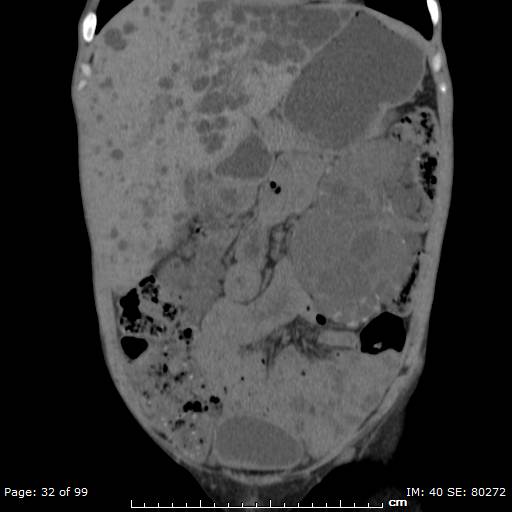 File:Autosomal dominant polycystic kidney disease (Radiopaedia 44122-47684 Coronal 15).jpg