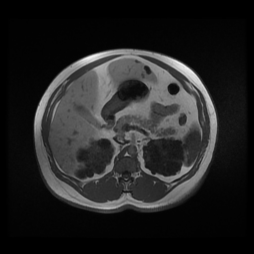 Autosomal dominant polycystic kidney disease (Radiopaedia 50259-55611 Axial 2D Dual Echo 38).jpg