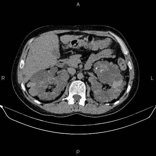 Autosomal dominant polycystic kidney disease (Radiopaedia 87830-104287 Axial non-contrast 21).jpg