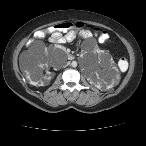 Autosomal dominant polycystic kidney disease with hepatic involvement (Radiopaedia 32693-33662 B 37).jpg