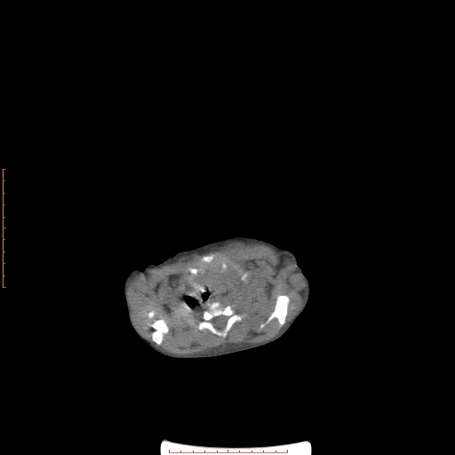 File:Autosomal recessive polycystic kidney disease associated with Caroli disease (Radiopaedia 61932-69984 Axial non-contrast 12).jpg