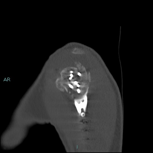 Avascular necrosis after fracture dislocations of the proximal humerus (Radiopaedia 88078-104653 Sagittal bone window 17).jpg