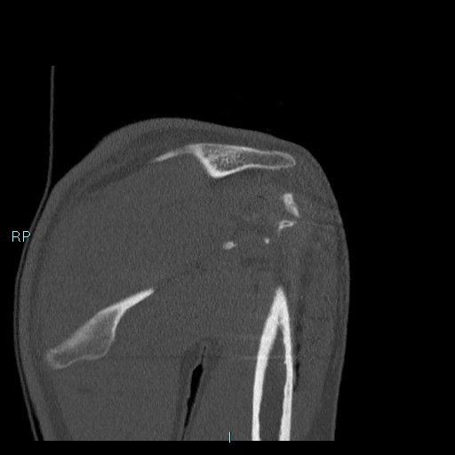 Avascular necrosis after fracture dislocations of the proximal humerus (Radiopaedia 88078-104655 Coronal bone window 57).jpg