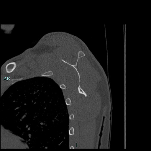 File:Avascular necrosis after fracture dislocations of the proximal humerus (Radiopaedia 88078-104655 Sagittal bone window 52).jpg