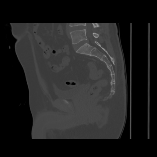 File:Avascular necrosis of the hip (Radiopaedia 61503-69467 B 31).jpg
