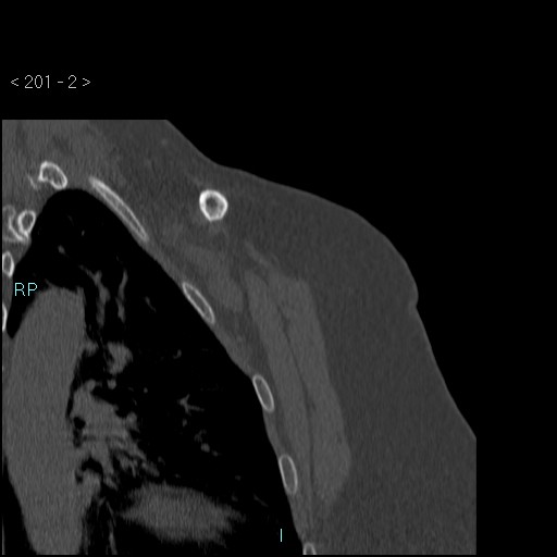 Avascular necrosis of the shoulder - Cruess stage I (Radiopaedia 77674-89887 Coronal bone window 1).jpg
