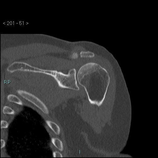 Avascular necrosis of the shoulder - Cruess stage I (Radiopaedia 77674-89887 Coronal bone window 50).jpg