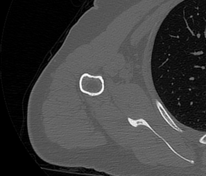 Avulsion fracture - greater tuberosity of humerus (Radiopaedia 71216-81514 Axial bone window 61).jpg