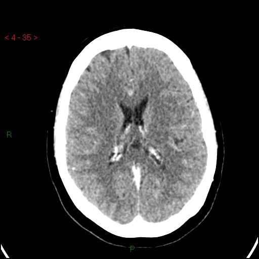 Azygos anterior cerebral artery (Radiopaedia 51987-57833 A 35).jpg