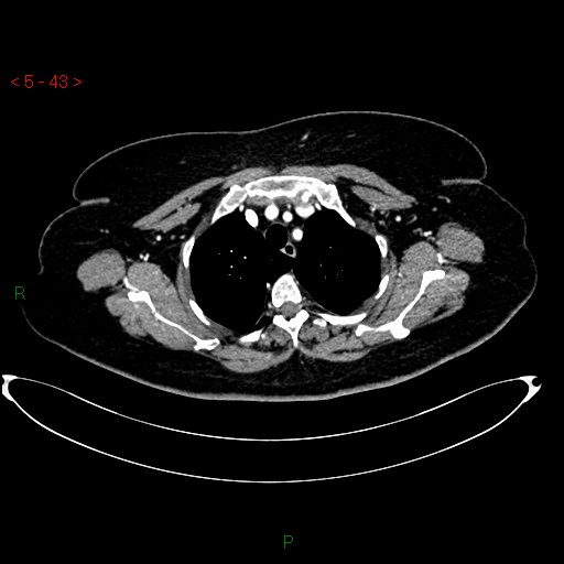 Azygos fissure and lobe (Radiopaedia 47620-52278 A 29).jpg