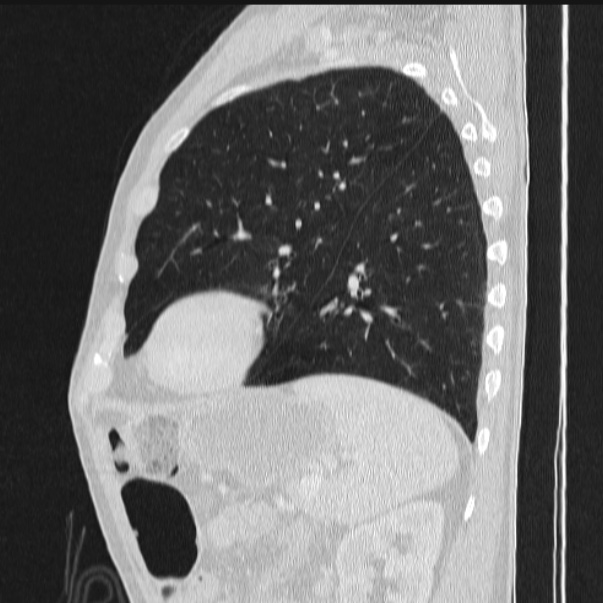 Azygos lobe (Radiopaedia 38259-40275 lung window 74).jpg