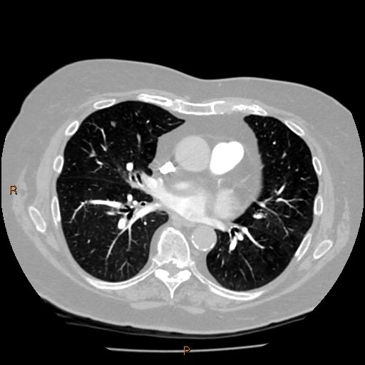 Azygos lobe (Radiopaedia 40161-42821 Axial lung window 39).jpg
