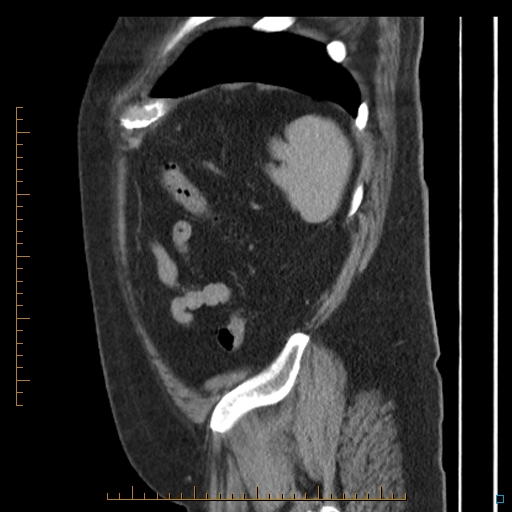 Bariatric balloon causing gastric outlet obstruction (Radiopaedia 54449-60672 C 12).jpg