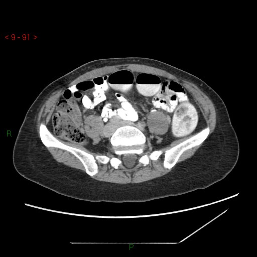 File:Bartholin gland cyst (Radiopaedia 54904-61181 Axial C+ delayed 23).jpg