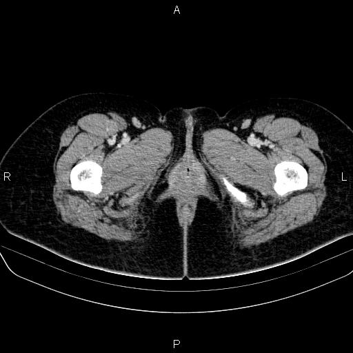 File:Bartholin gland cyst (Radiopaedia 62635-70930 Axial Post contrast 98).jpg