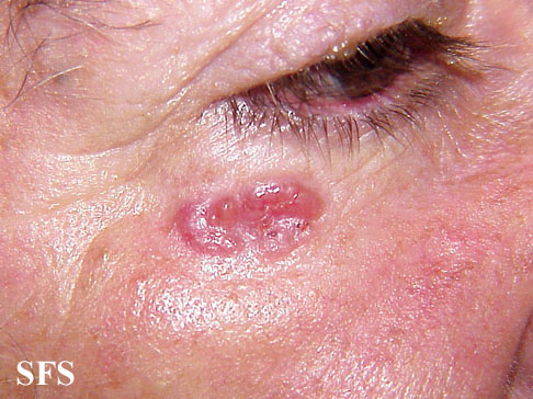 Basal Cell Carcinoma (Dermatology Atlas 98).jpg