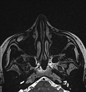 Basal cell carcinoma - nasal region (Radiopaedia 70292-80365 Axial Gradient Echo 31).jpg