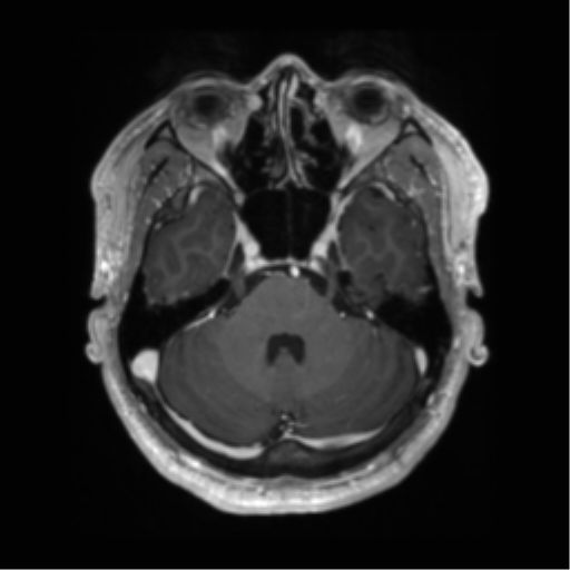 Basal ganglia hemorrhage - hypertensive (Radiopaedia 42227-45303 Axial T1 C+ 36).png