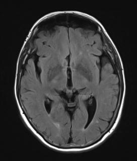 File:Base of skull chondrosarcoma (Radiopaedia 30410-31070 Axial FLAIR 10).jpg