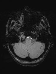 Base of skull chondrosarcoma (Radiopaedia 30410-31070 Axial SWI 11).jpg