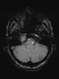 Base of skull chondrosarcoma (Radiopaedia 30410-31070 Axial SWI 12).jpg