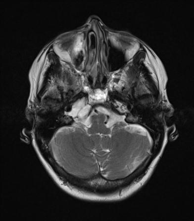 File:Base of skull chondrosarcoma (Radiopaedia 30410-31070 Axial T2 5).jpg