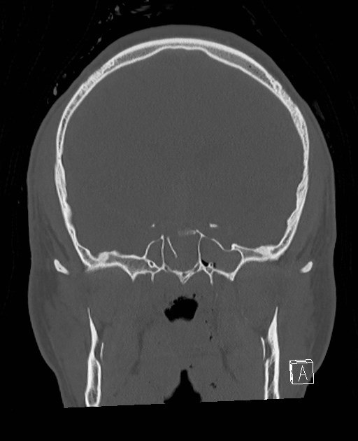 Base of skull fracture with bilateral Le Fort fractures (Radiopaedia 47094-51638 Coronal bone window 58).jpg