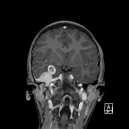 Base of skull rhabdomyosarcoma (Radiopaedia 32196-33142 I 36).jpg