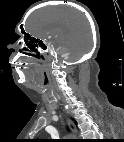 File:Basilar artery aneurysm (Radiopaedia 56261-62932 C 21).jpg