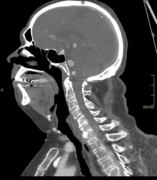 Basilar artery aneurysm (Radiopaedia 56261-62932 C 31).jpg