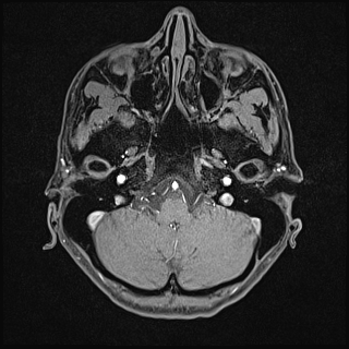 Basilar artery perforator aneurysm (Radiopaedia 82455-97733 Axial T1 fat sat 25).jpg